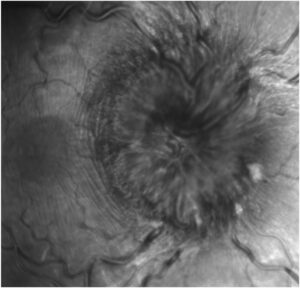 Clinical image illustrating Paton Lines (Disc Folds)