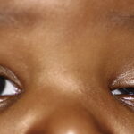 Clinical eye photograph illustrating Pediatric Blepharoptosis Amblyopia Risk