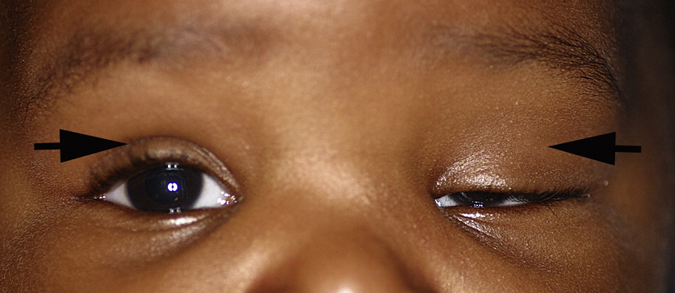 Pediatric Blepharoptosis: When Drooping Eyelids Threaten Vision, Not Just Appearance
