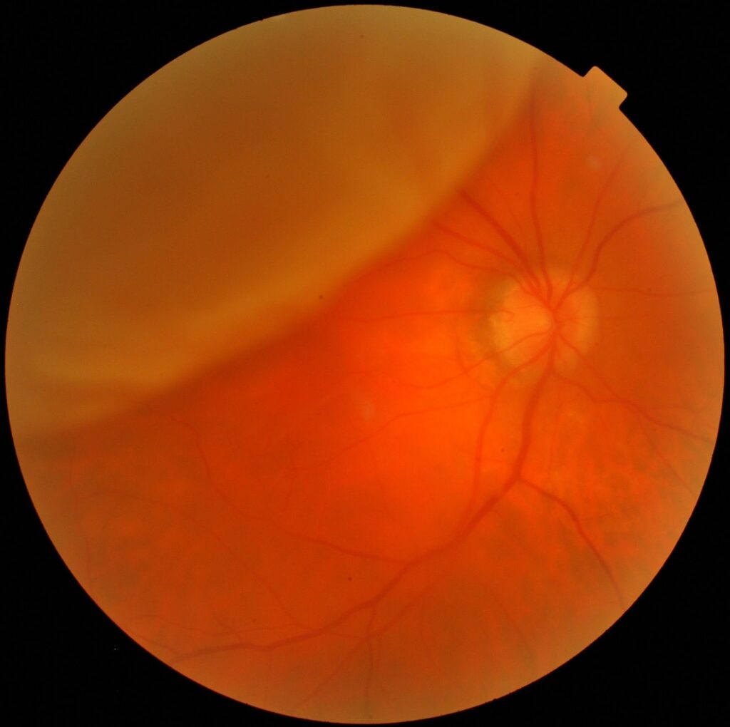 Clinical eye photograph illustrating Pediatric Retinal Detachment