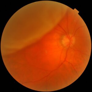 Clinical eye photograph illustrating Pediatric Retinal Detachment