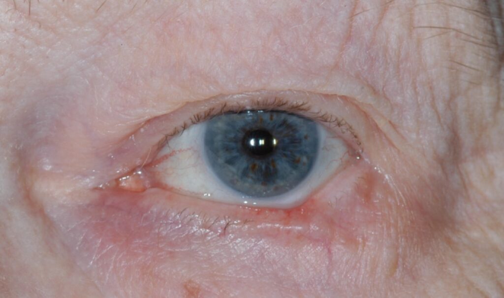 Clinical eye photograph illustrating Periocular Basal Cell Carcinoma Reconstruction