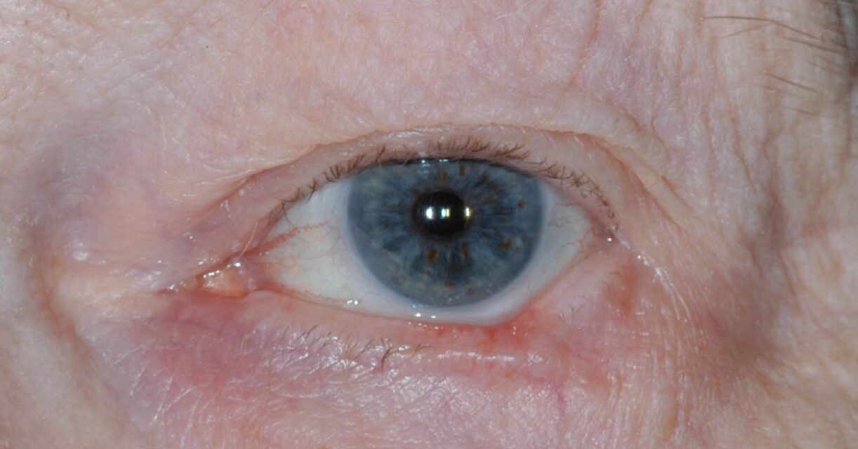 Periocular Basal Cell Carcinoma: Reconstruction Planned Around the Defect, Not the Diagnosis