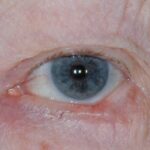 Clinical eye photograph illustrating Periocular Basal Cell Carcinoma Reconstruction