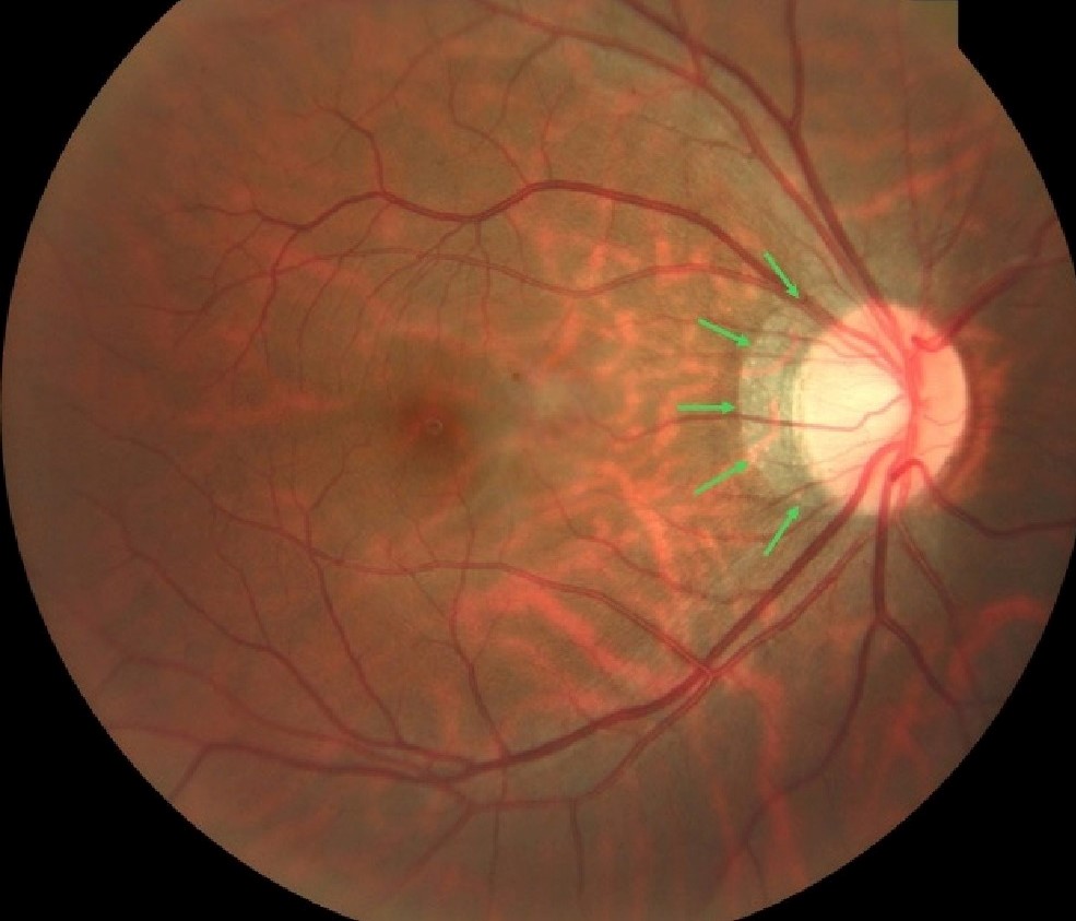 Clinical image illustrating Peripapillary Atrophy (figure 1)