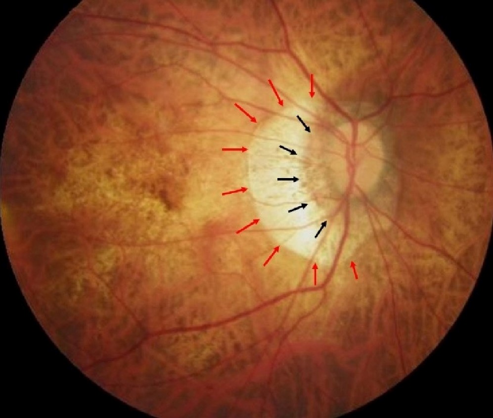 Clinical image illustrating Peripapillary Atrophy (figure 2)