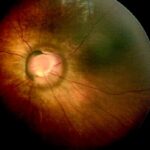 Clinical eye photograph illustrating Peripapillary Staphyloma