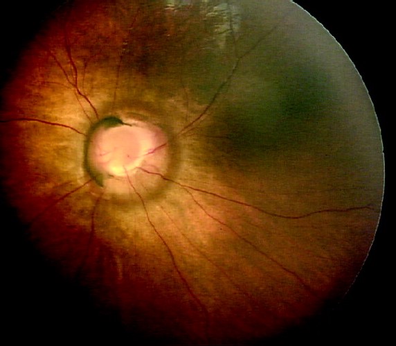 Peripapillary Staphyloma: A Deep Excavation That Is Not Glaucoma
