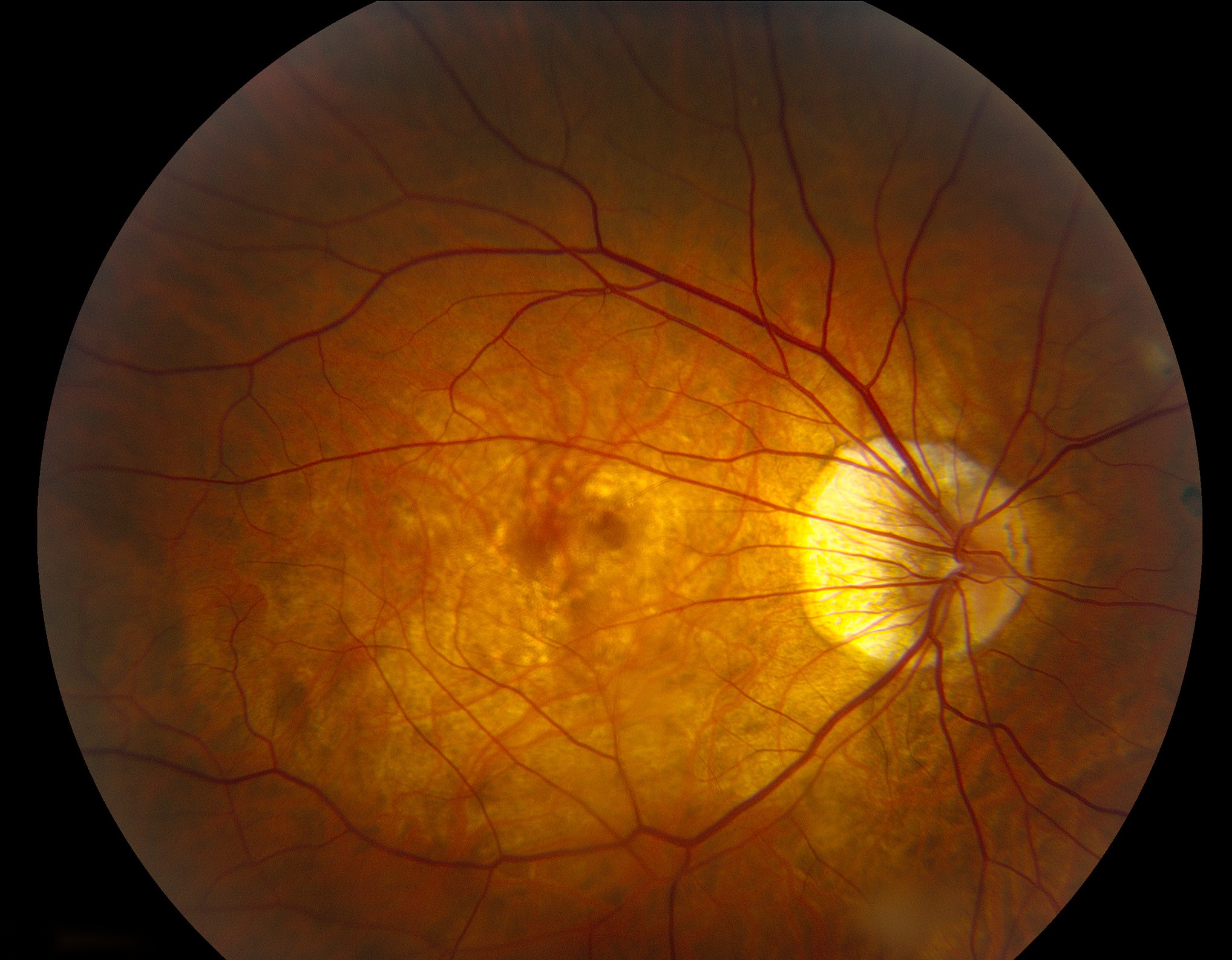 Clinical eye photograph illustrating Peripapillary Staphyloma