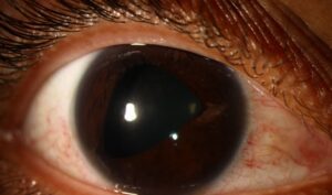 Clinical image illustrating Peripheral Anterior Synechiae (PAS)