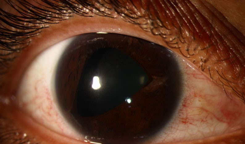 Clinical image illustrating Peripheral Anterior Synechiae (PAS)