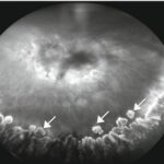 Clinical eye photograph illustrating Peripheral Cobblestone Degeneration