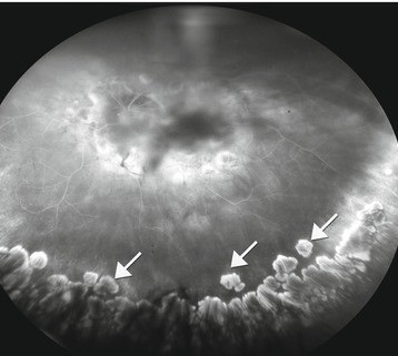 Clinical eye photograph illustrating Peripheral Cobblestone Degeneration