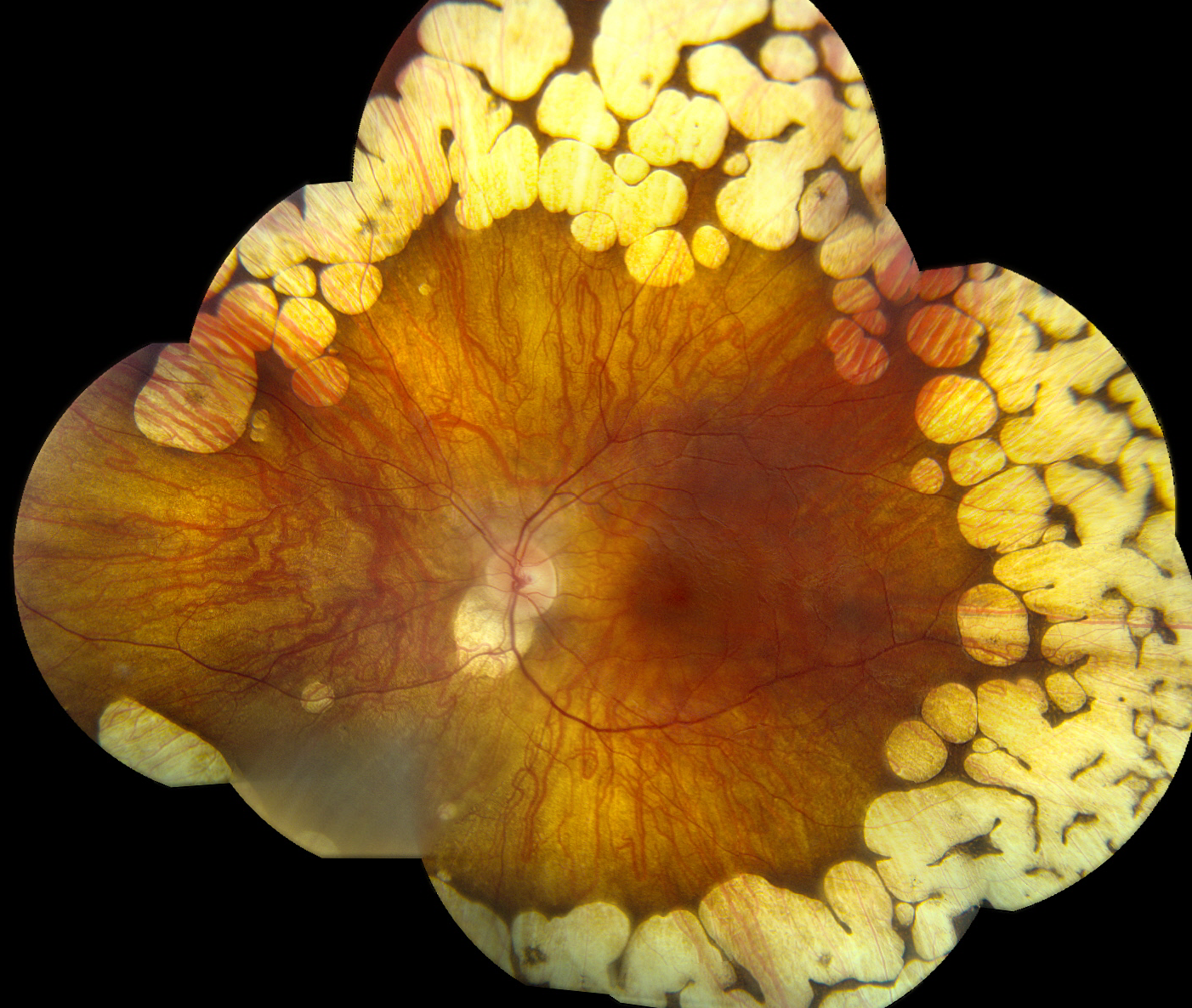 Clinical eye photograph illustrating Peripheral Cobblestone Degeneration