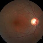 Clinical eye photograph illustrating Peripheral Retinal Drusen vs Macular