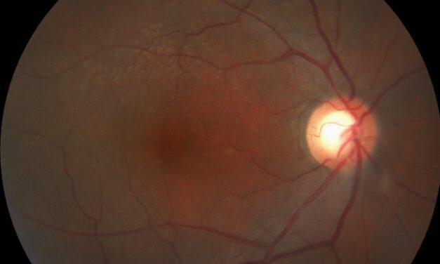 Peripheral Retinal Drusen: Similar Dots, Different Meaning Away From the Macula