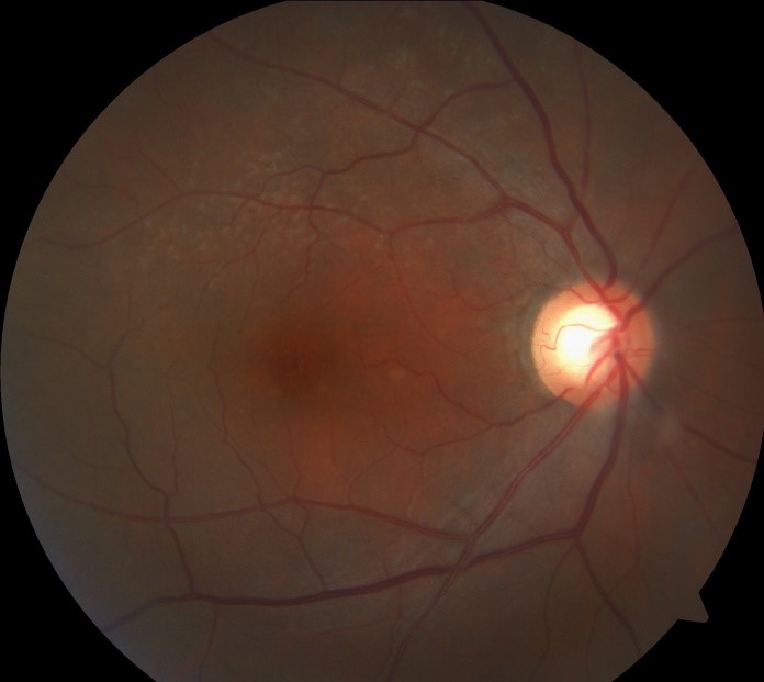 Clinical eye photograph illustrating Peripheral Retinal Drusen vs Macular