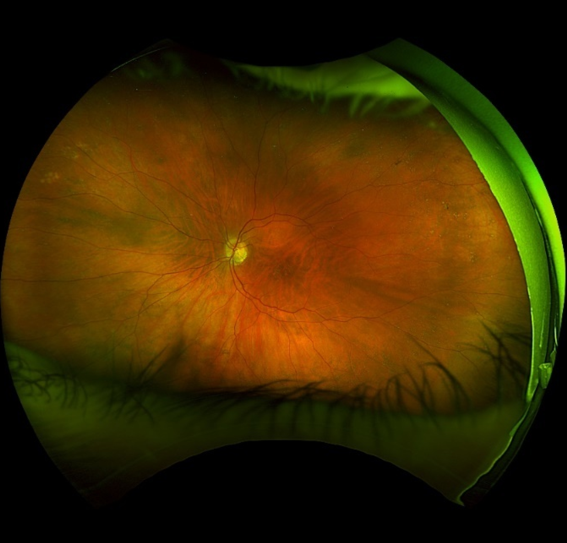 Clinical eye photograph illustrating Peripheral Retinal Drusen vs Macular