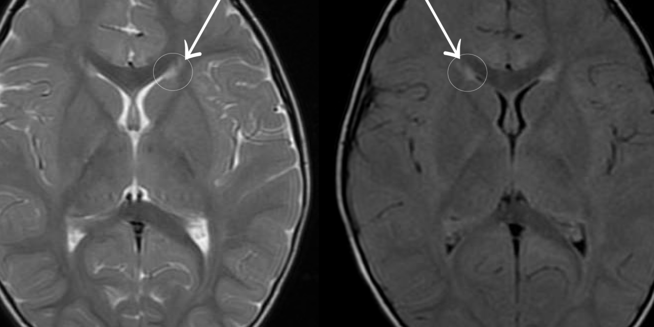 Periventricular Leukomalacia and Visual Outcome: Why the Damage Can Be in the Brain, Not the Eye