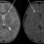 Clinical eye photograph illustrating Periventricular Leukomalacia Visual Outcome