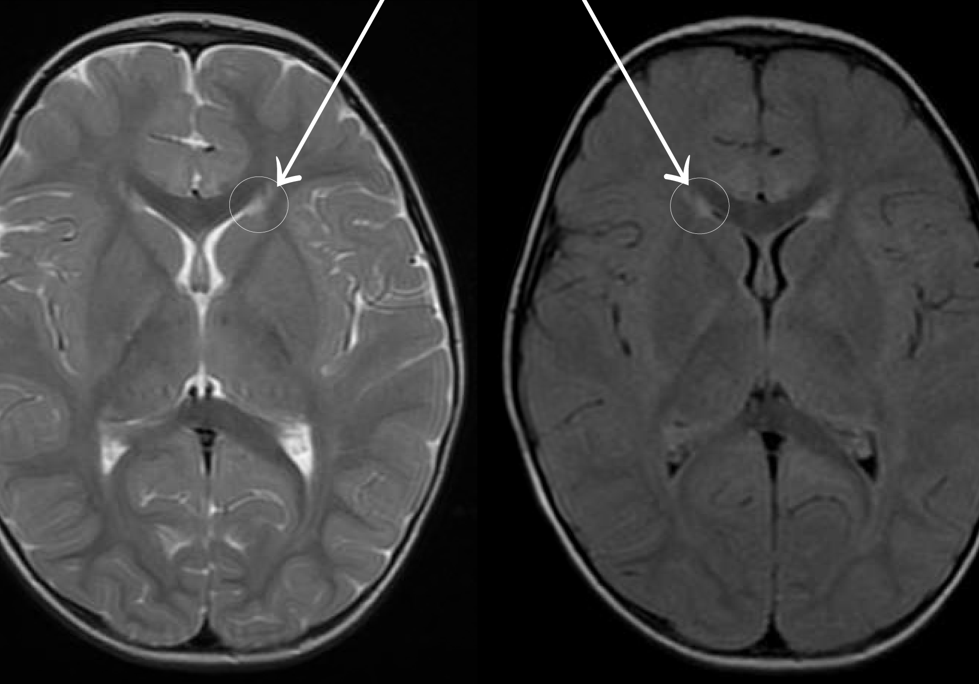 Clinical eye photograph illustrating Periventricular Leukomalacia Visual Outcome
