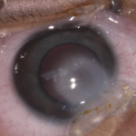 Clinical eye photograph illustrating Peters Anomaly Classification