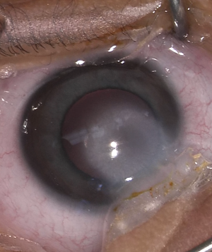 Peters Anomaly: When Development Never Separates the Lens From the Cornea