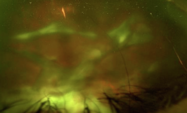 Clinical eye photograph illustrating Phacoanaphylactic Endophthalmitis