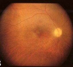 Clinical eye photograph illustrating Phacoanaphylactic Endophthalmitis