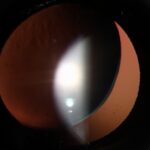 Clinical eye photograph illustrating Phacodonesis