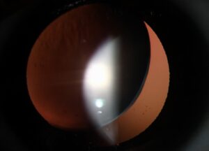 Clinical eye photograph illustrating Phacodonesis