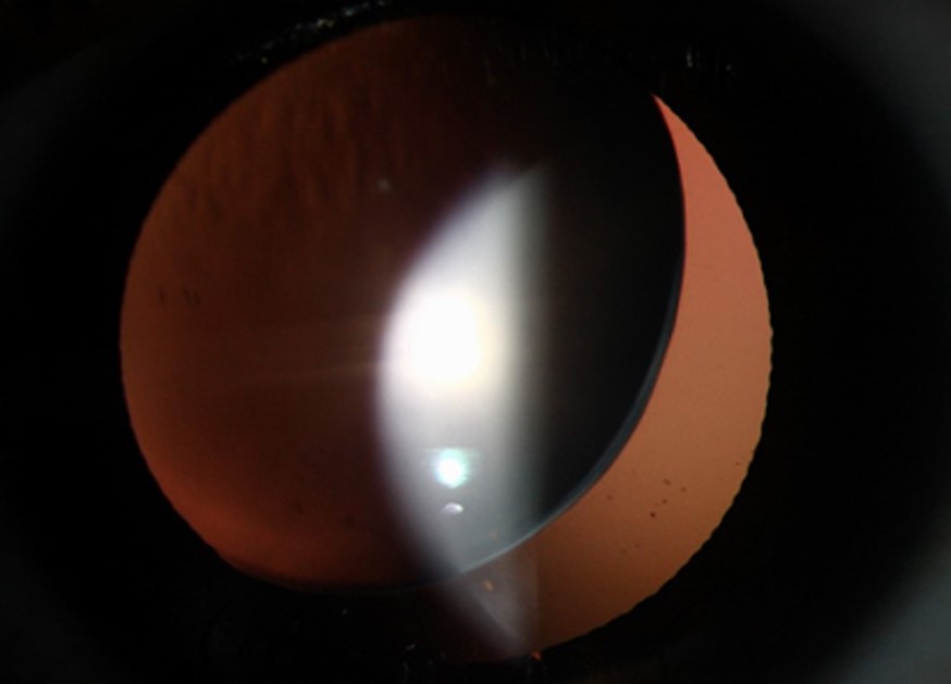 Clinical eye photograph illustrating Phacodonesis