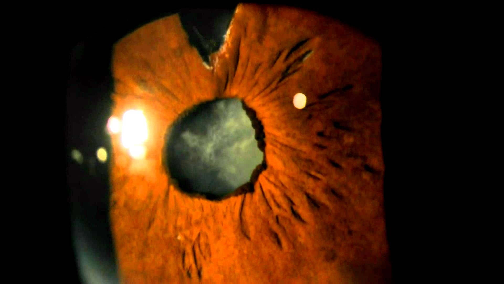 Clinical eye photograph illustrating Phacodonesis