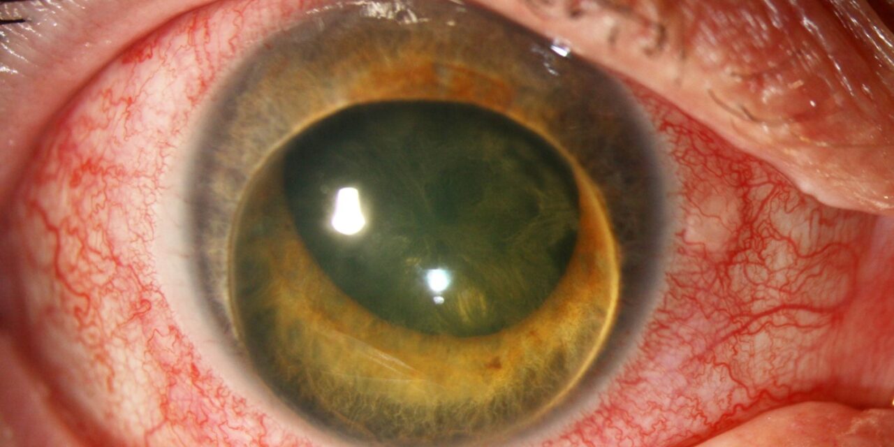 Phacomorphic Glaucoma: An Acute Emergency Created by a Swelling Lens