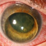 Clinical eye photograph illustrating Phacomorphic Glaucoma Emergency Management