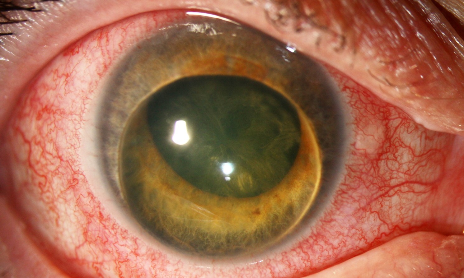 Clinical eye photograph illustrating Phacomorphic Glaucoma Emergency Management