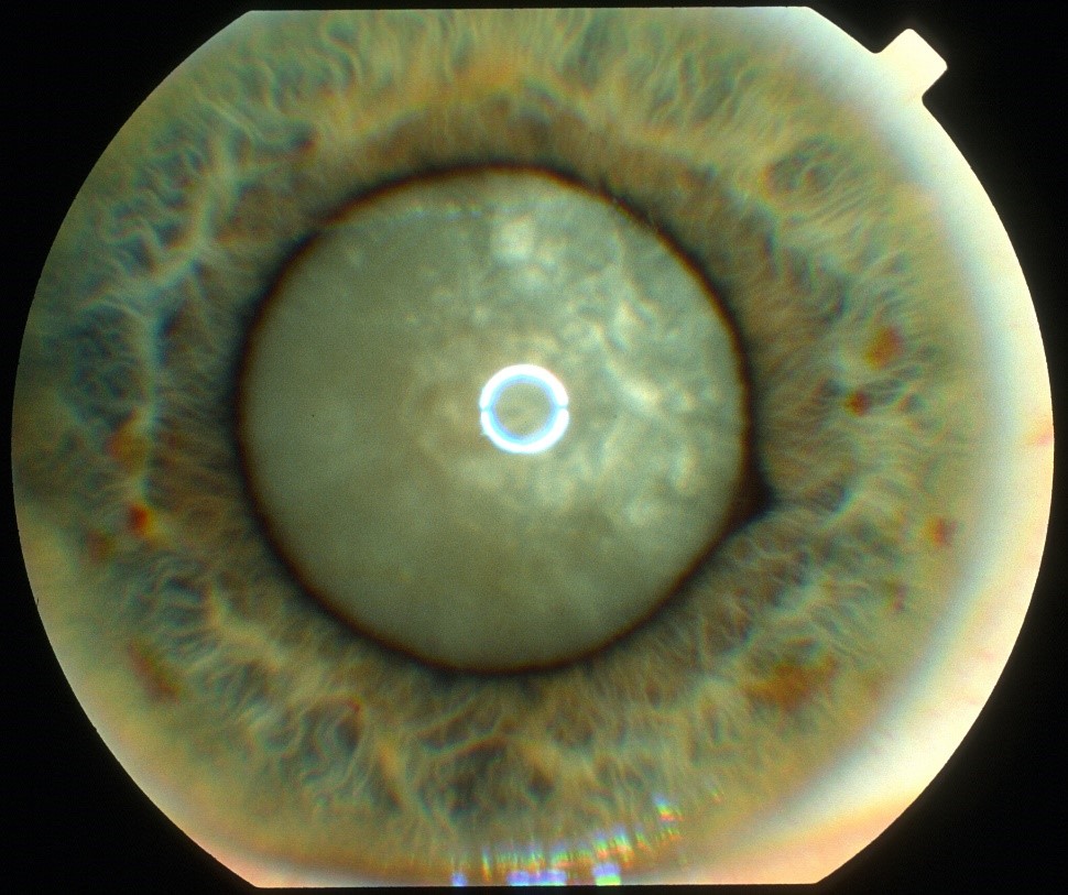 Clinical eye photograph illustrating Phacomorphic Glaucoma Emergency Management