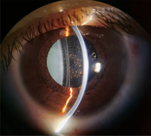 Clinical image illustrating Pharmacologic Mydriasis (Fixed Big Pupil)