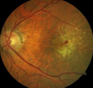 Clinical eye photograph illustrating Photostress Test Macula Versus Optic Nerve