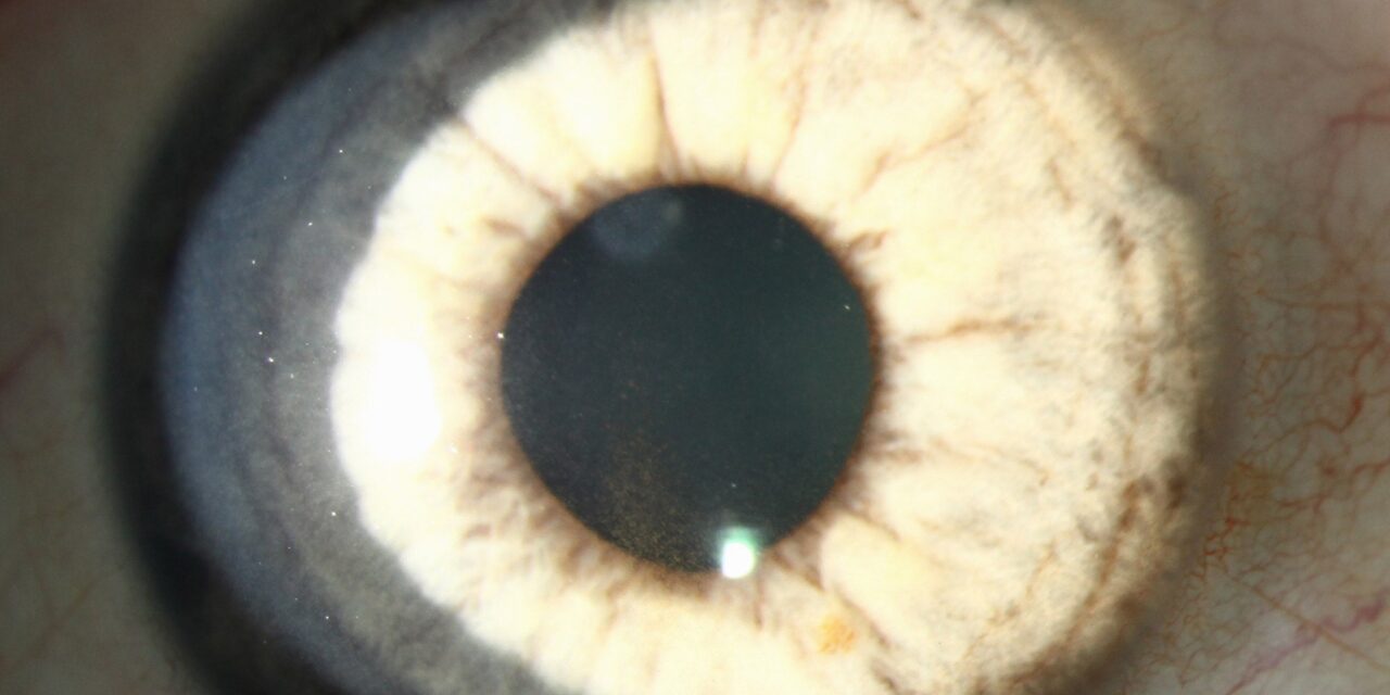 Pigmentary Glaucoma: When the Syndrome Finally Crosses the Line Into Disease