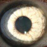 Clinical eye photograph illustrating Pigmentary Glaucoma