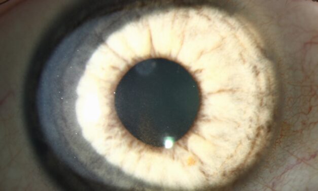 Pigmentary Glaucoma: When the Syndrome Finally Crosses the Line Into Disease
