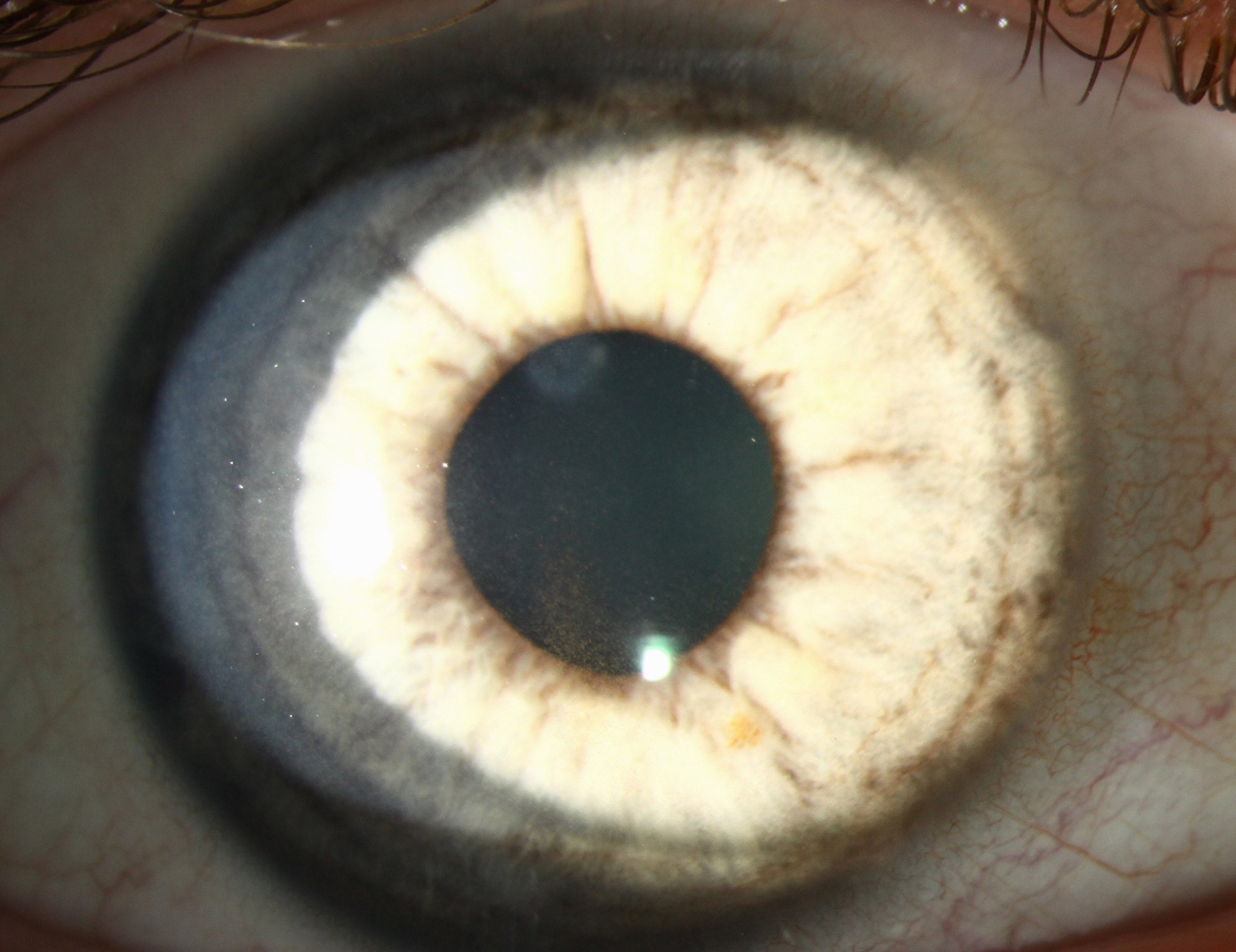 Clinical eye photograph illustrating Pigmentary Glaucoma