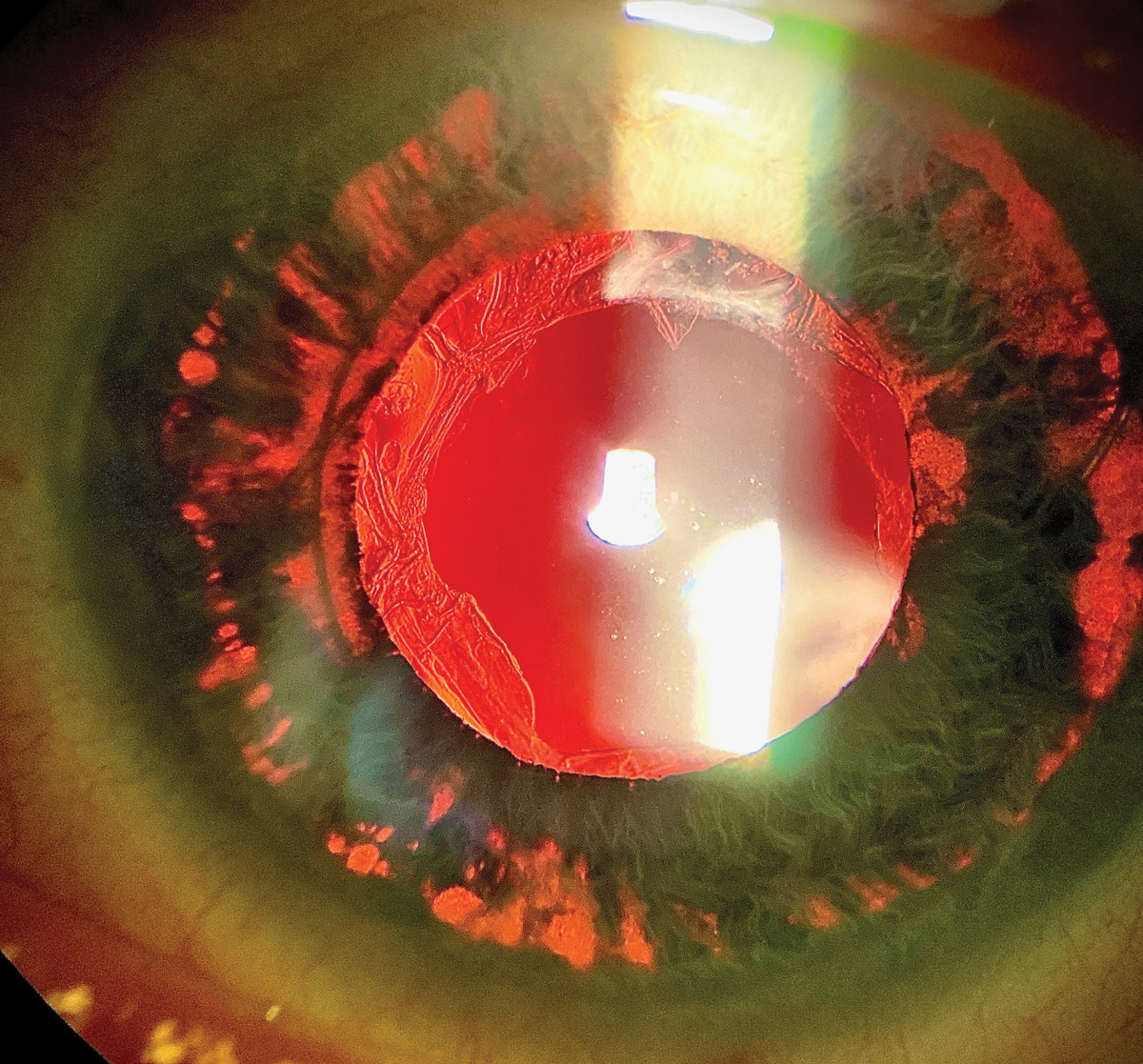 Clinical eye photograph illustrating Pigmentary Glaucoma
