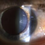 Clinical image illustrating Pinguecula vs Pterygium