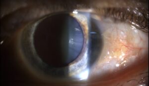 Clinical image illustrating Pinguecula vs Pterygium