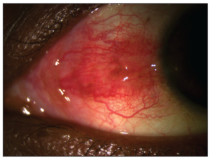 Clinical image illustrating Pingueculitis (Inflamed Pinguecula) (figure 1)