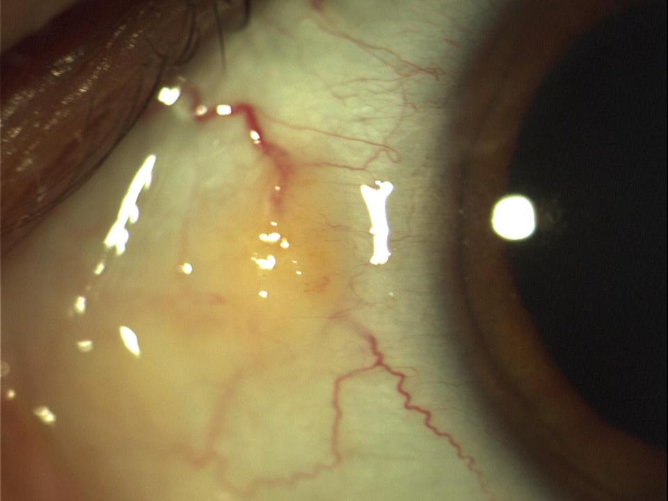 Clinical image illustrating Pingueculitis (Inflamed Pinguecula) (figure 2)