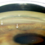 Clinical eye photograph illustrating Plateau Iris Syndrome Management