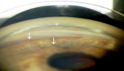 Plateau Iris Syndrome: Angle Closure With a Ciliary Body Twist